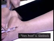 Loadmedical - Medizinische Filme - Akupunkturbehandlung vom Somatotop