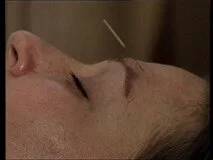Loadmedical - Medizinische Filme - Akupunkturbehandlung vom Somatotop
