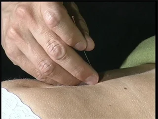 Nadelstichtechniken in der Akupunktur -DVD-Version